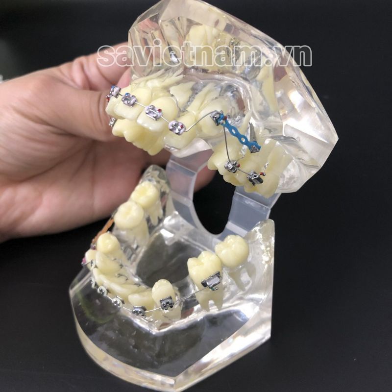 Hàm tư vấn chỉnh nha full khí cụ có nhổ răng trong nha khoa