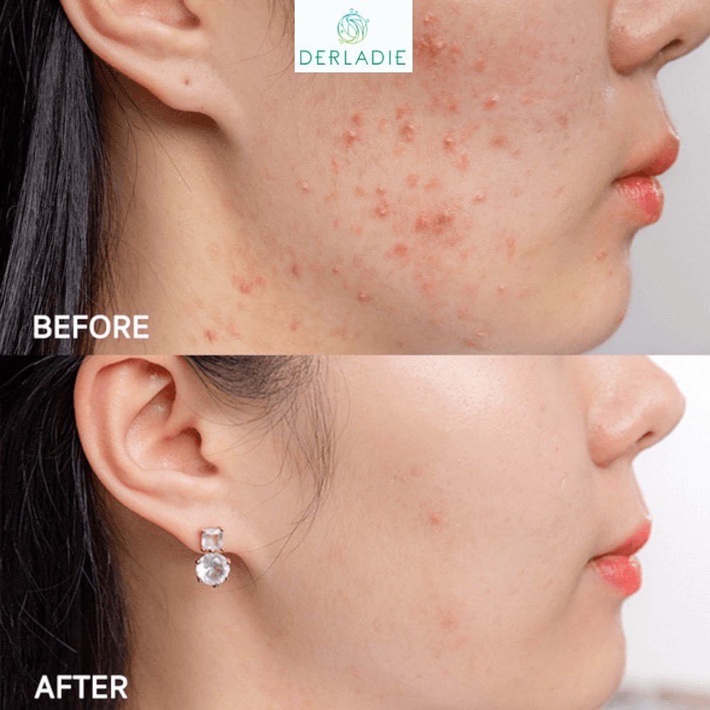 Bộ đôi Toner và Tinh Chất Tràm Trà giảm mụn sau 14 ngày Derladie Herbal For Blemish