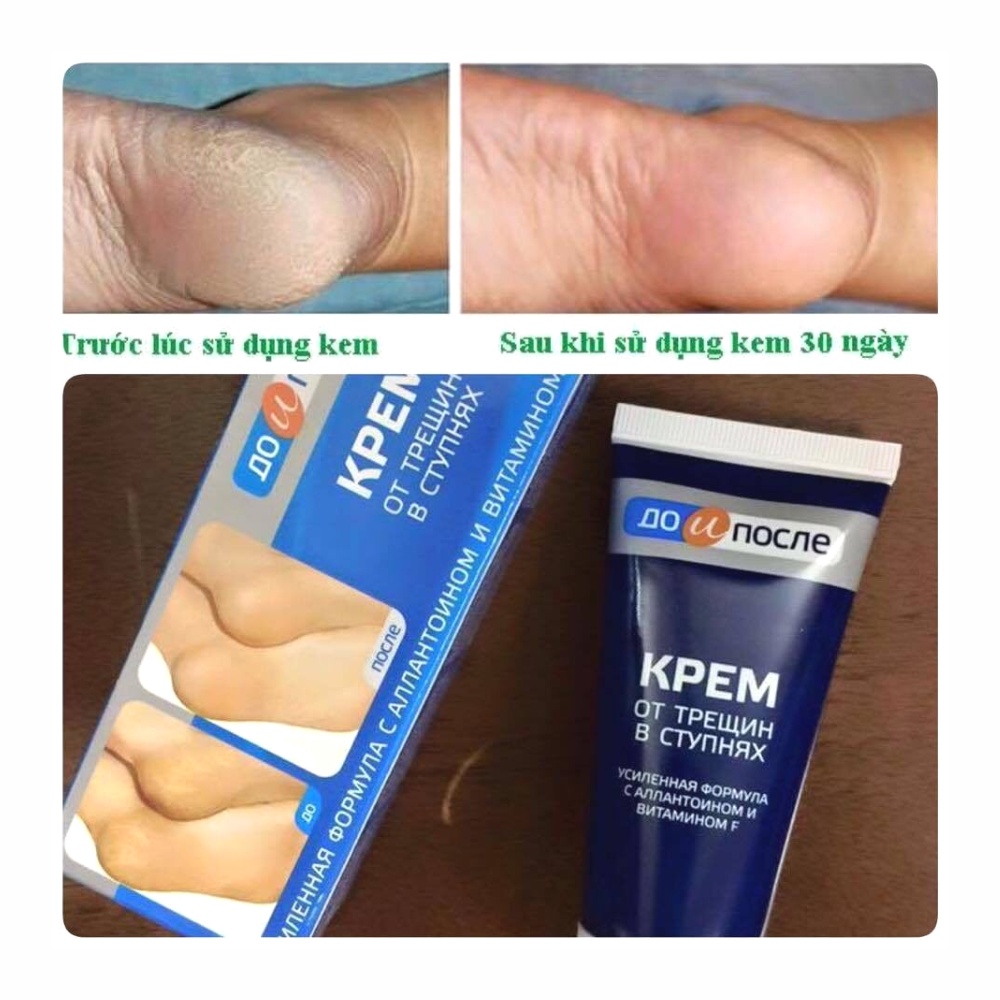 Kem làm giảm nứt nẻ gót chân KPEM 50ml hàng nội địa Nga