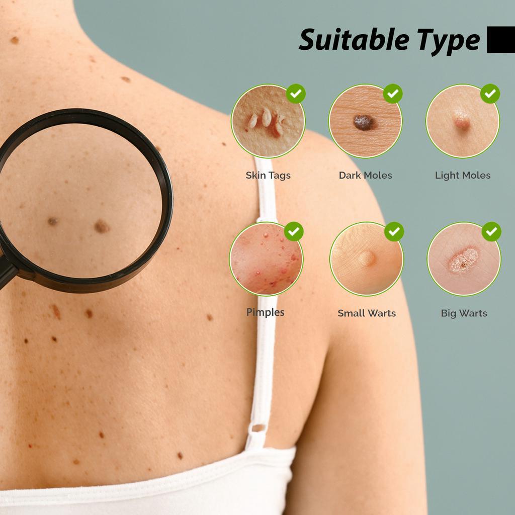 (Xài là hết) ACLIVE SKIN serum tẩy nốt ruồi hiệu quả rõ rệt đối với mụn thịt, mụn cóc, nốt ruồi, tàn nhang v.v...