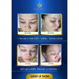 serum  mụn halora