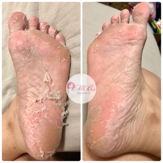 Mặt nạ peel da chân My Scheming Đài Loan