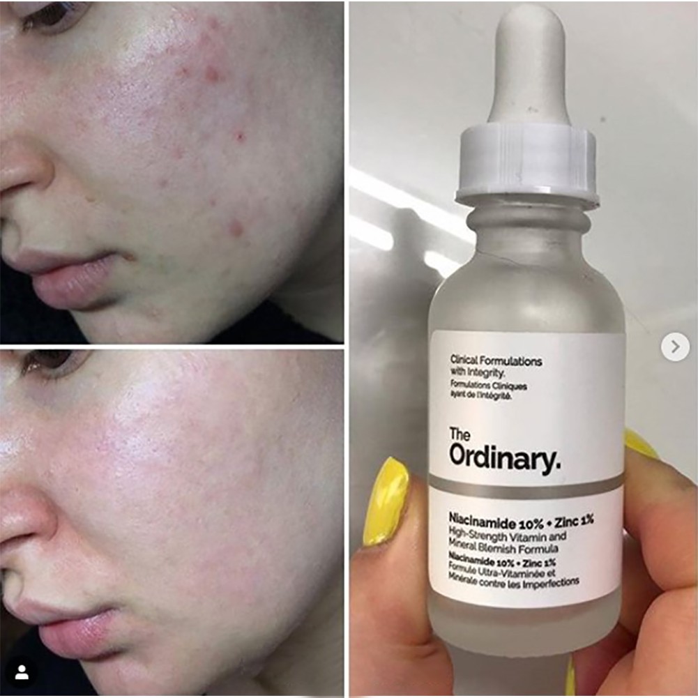 Tinh chất The Ordinary Niacinamide 10% + Zinc 1% Serum 30ml | BigBuy360 - bigbuy360.vn
