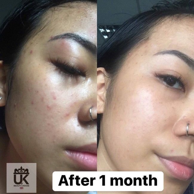 Combo 4 sản phẩm ngăn ngừa mụn tràm trà gel rửa mặt + tẩy da chết + toner + gel chấm mụn T-Zone | BigBuy360 - bigbuy360.vn