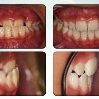 (A1+A2+A3) DỤNG CỤ NIỀNG RĂNG CHO NGƯỜI LỚN