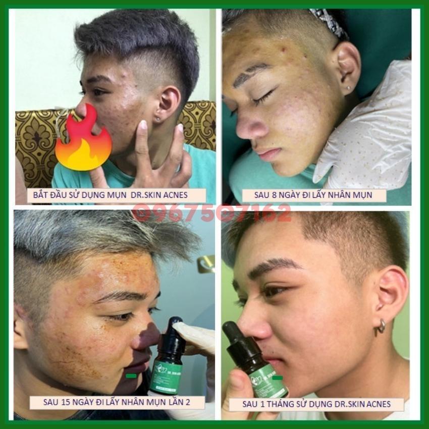 Serum Dr.Skinacnes, serum sạch mụn thâm Dr skinacnes 5ml giúp sạch bay mụn hết thâm làm mịn da hiệu quả trong 7 ngày