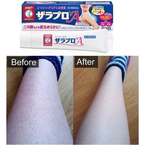 Kem Viêm Nang Lông Zaraporo Rohto Nhật Bản 35g
