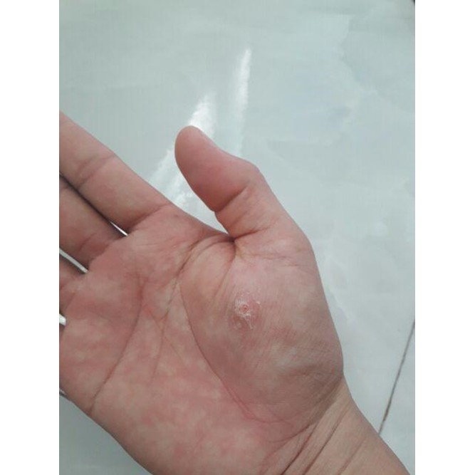 Có Bill- Miếng dán mụn cóc,mắt cá chân, chai sần tay chân CONR CAPS của Anh Quốc