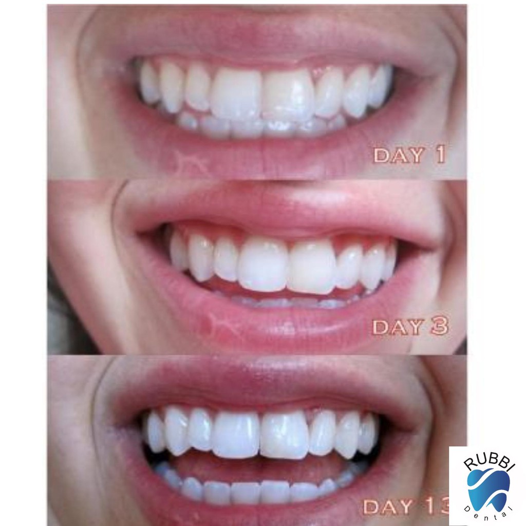 Miếng dán trắng răng 3D,5D white teeth whitening trắng răng bật tông trong 7 ngày sử dụng