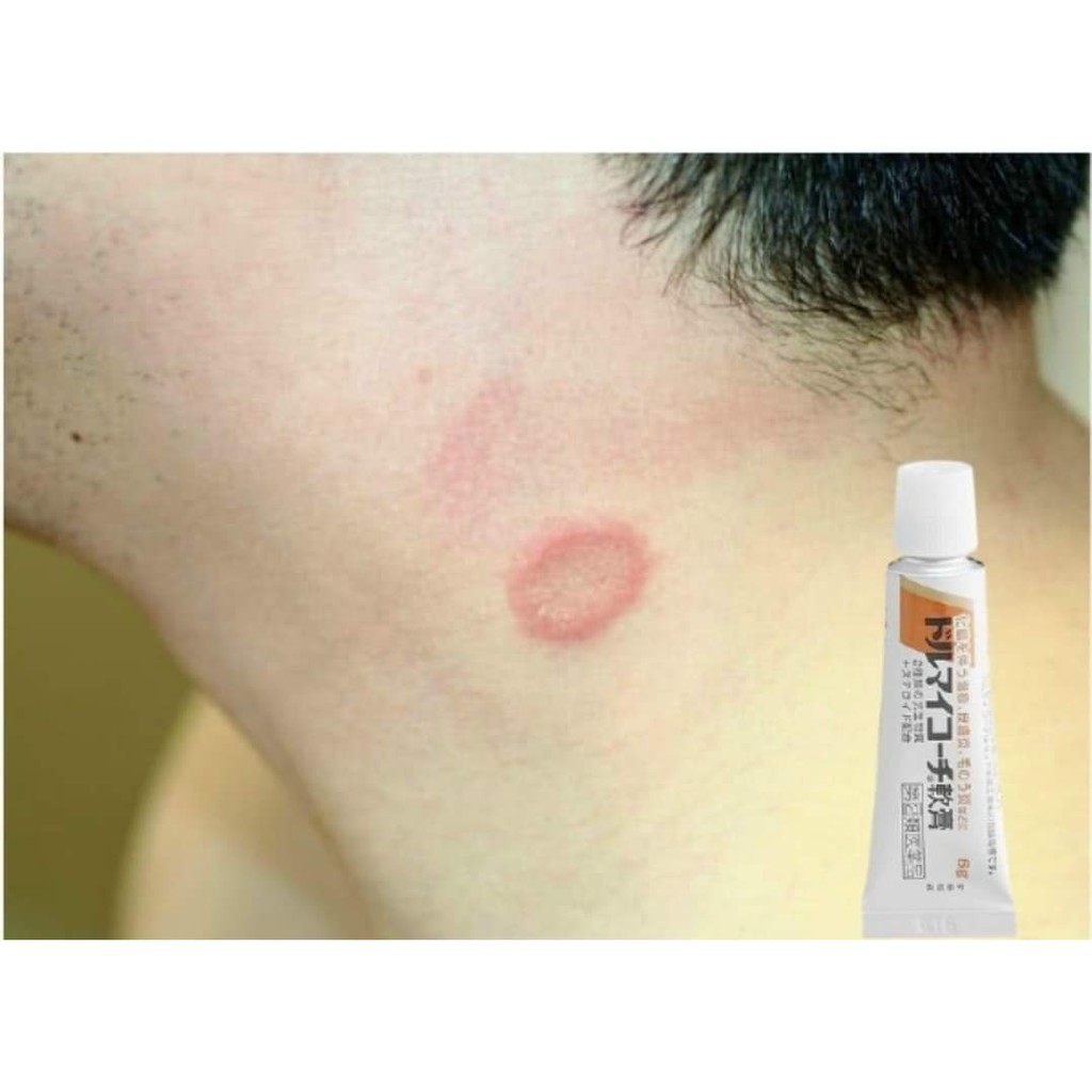 Gel loại bỏ vảy nến Dormycin Zeria
