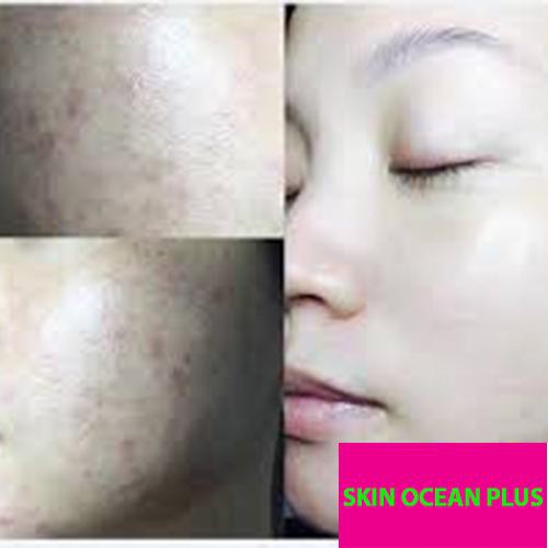 KEM TRỊ MỤN SKIN OCEAN PLUS - TRỊ MỤN TẬN GỐC , HIỆU QUẢ 99% -  NGĂN NGỪA TÁI PHÁT | BigBuy360 - bigbuy360.vn