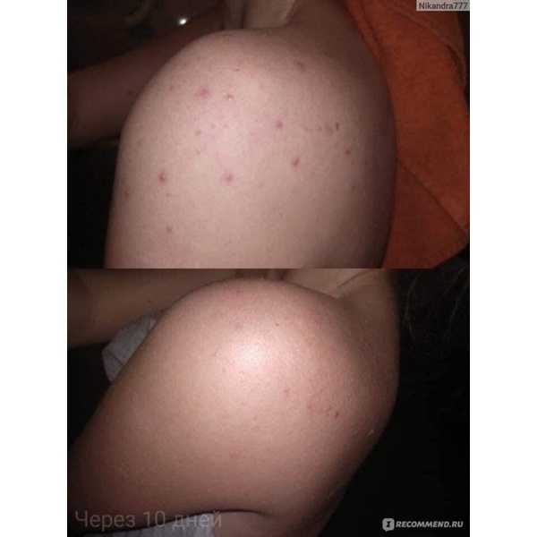 [Hiệu quả] XÀ PHÒNG GIẢM MỤN LƯNG VÀ THÂM XUẤT XỨ NGA