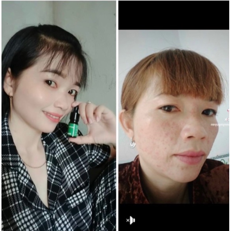 Serum mụn Dr skinacnes, serum giảm mụn, mờ thâm 5ml