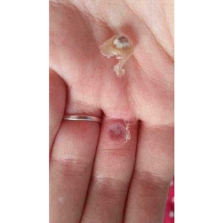 Bôi mụn cóc, mụn ruồi CONCON Thái lan
