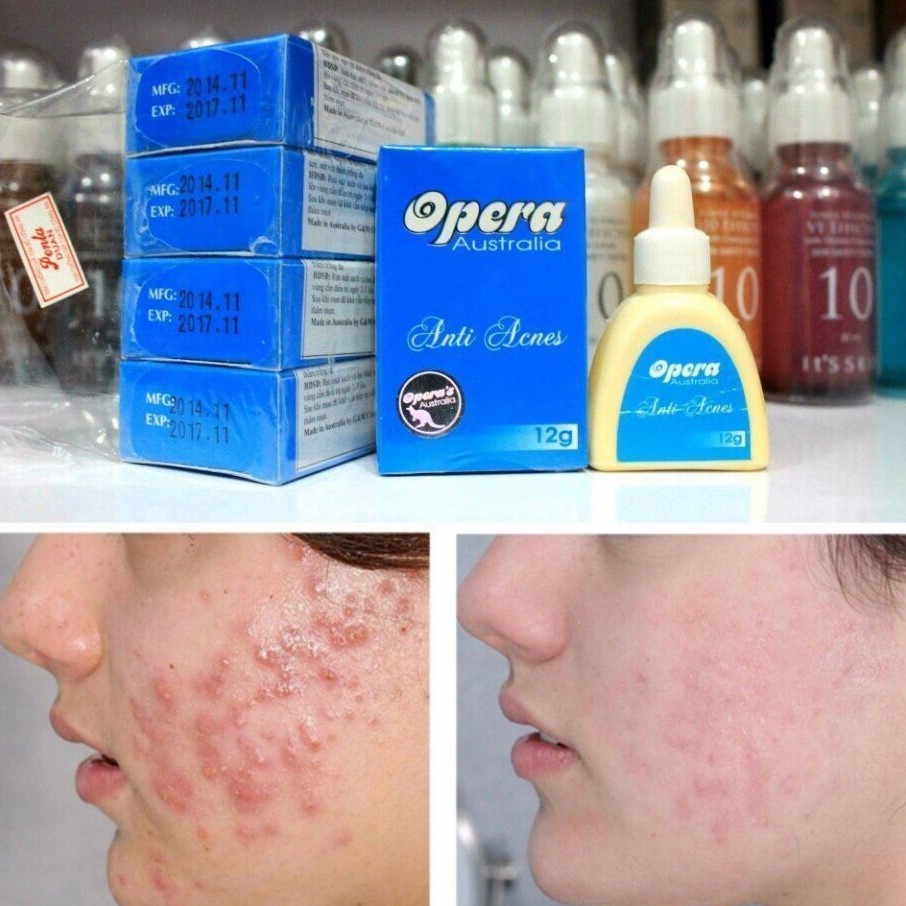 Kem ngừa mụn và liền sẹo Opera Australia Anti Acnes 12g (Hộp xanh: mụn mủ, mụn bọc, mụn sưng tấy)