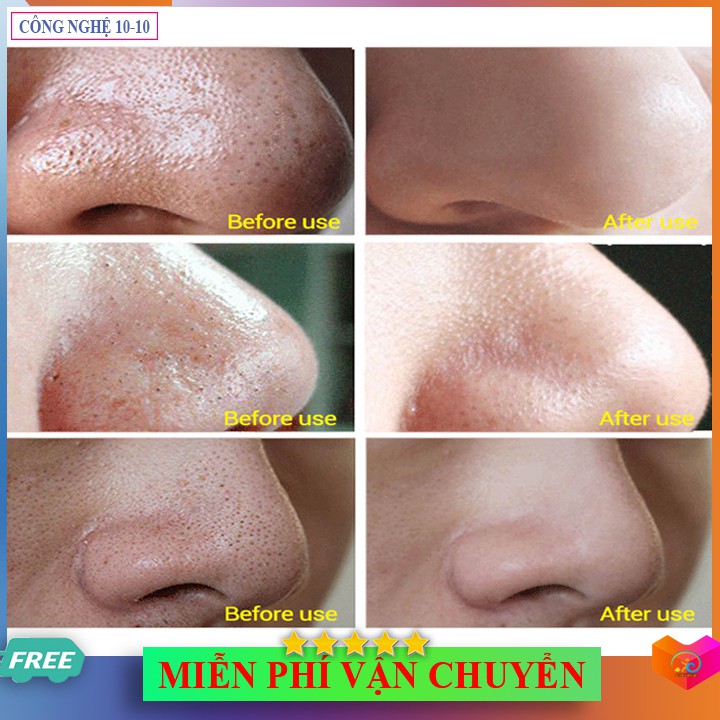 Máy Hút Mụn RT8080,8030 Siêu Sạch Với 5 Cấp Độ Làm Căn Da Xóa Nếp Nhăn - 92tien | BigBuy360 - bigbuy360.vn