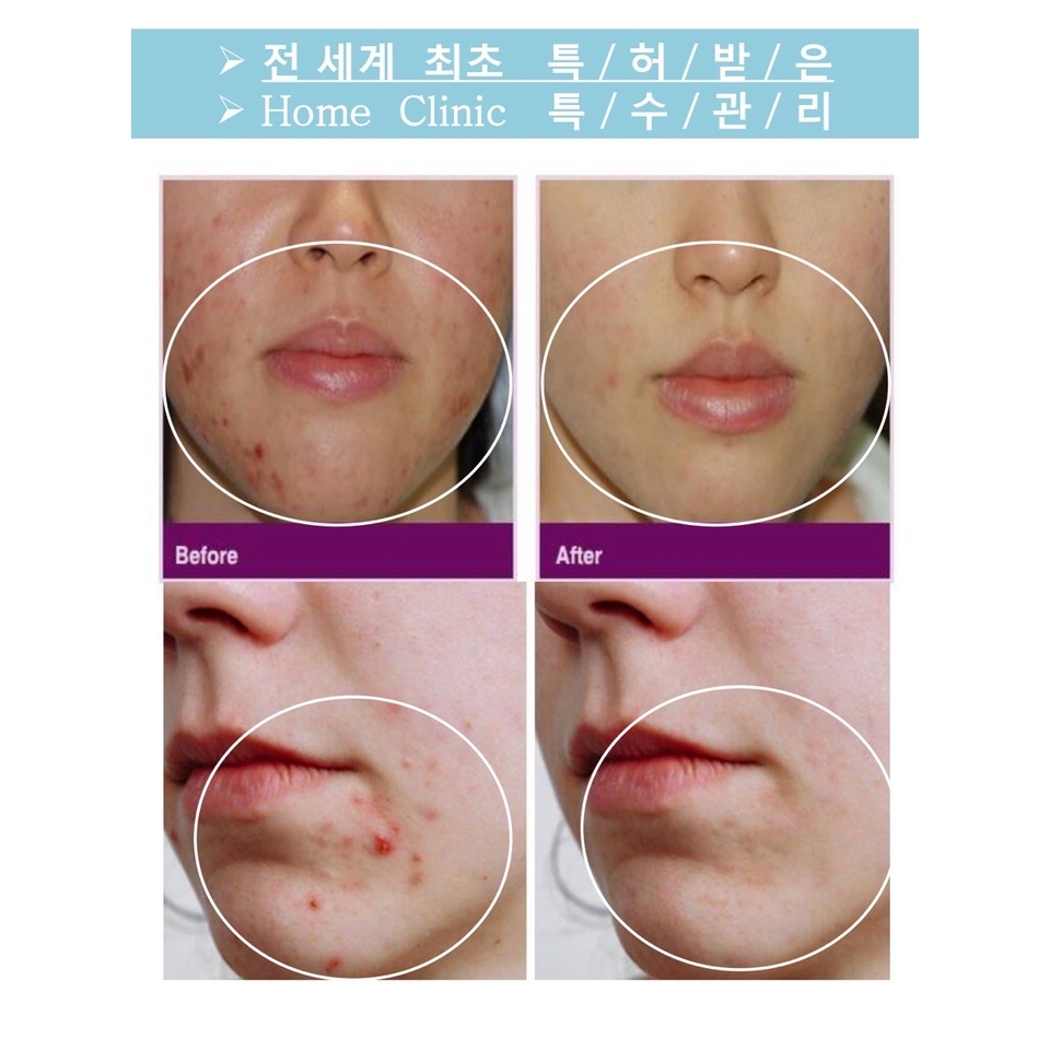 EXP12/2023] Miếng pad xịt mát lạnh cực cool SUPRARX Baby Pore Air Pad