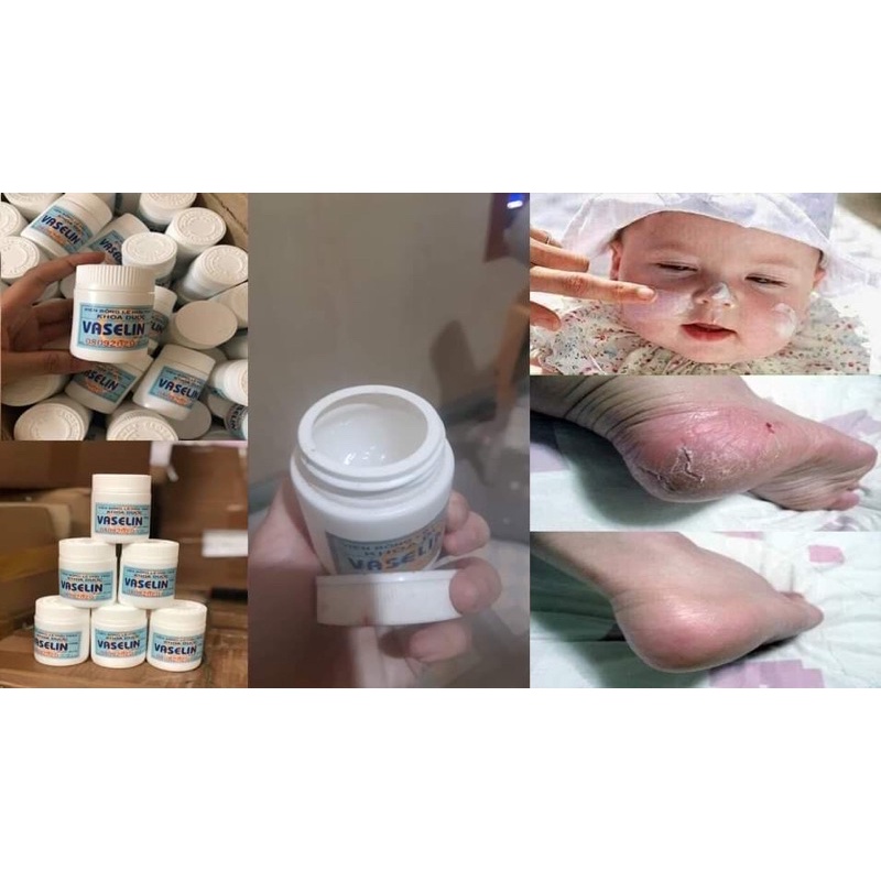 Kem nẻ dưỡng da vasellin viện bỏng 100g hiệu quả ngay lần sử dụng đầu tiên