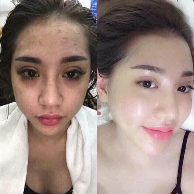 [ COMPO Ủ TRẮNG KÉN TẰM+ KEM FACE CẤY TRẮNG 570k sale360k] | BigBuy360 - bigbuy360.vn