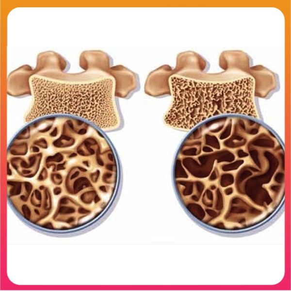 Siro Boncare Gold Golden Health USA – Bổ sung canxi, ngừa loãng xương, còi xương, thấp còi, suy dinh dưỡng - Bonecare