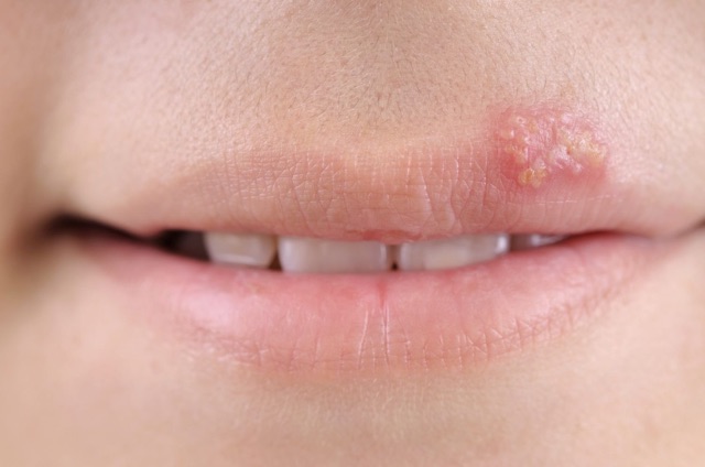 MIẾNG DÁN ĐIỀU TRỊ MỤN RỘP (HERPES) MÔI | BigBuy360 - bigbuy360.vn