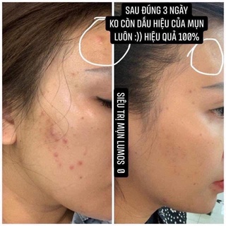 [Bản Cải Tiến 2021] Serum Lumos Acne Ngừa Mụn