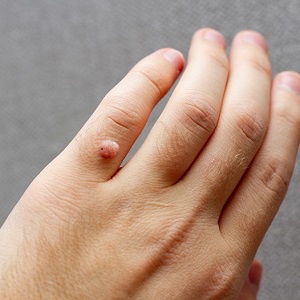 Mụn Cơm, Mụn Cóc, Mắt Cá Chân, Vết Chai Sần Acid Trivhloracetic 80% - Sống Chất 24h | BigBuy360 - bigbuy360.vn