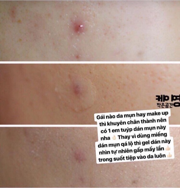 Gel dán mụn thần thánh Prreti Second Skin Patch 10g | BigBuy360 - bigbuy360.vn