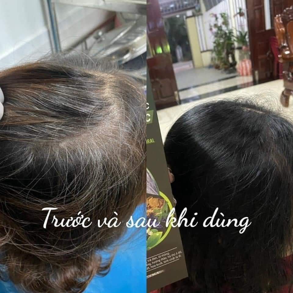 Tinh Chất Thảo Mộc Làm Đen Tóc Mẹ Ken