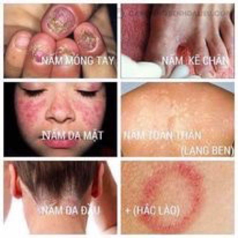 Kem bôi ngứa ❤️ Nứt nẻ chân tay ❤ Vảy Nến, Á Sừng