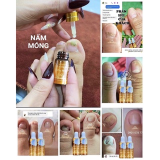 phục hồi móng hư tổn