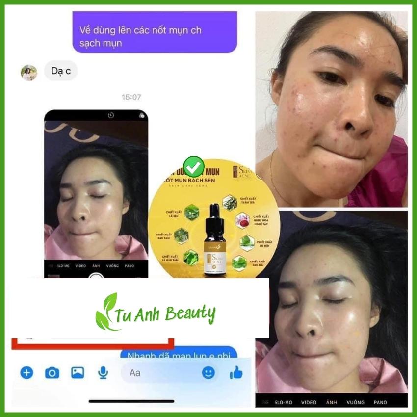 Cốt mụn Bạch Sen Lskin Đan Thy - sản phẩm chính hãng