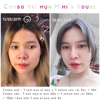 KEM MỤN BÍ ĐAO SIZE LỚN 20G