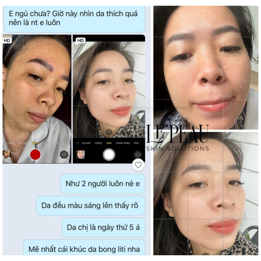 - Peel Da Vi Tảo Retinol Le'Peau Hoàng Thiên Sâm Tái Tạo Da 10ml 3-7 Ngày Xong Liệu Trình Bong da