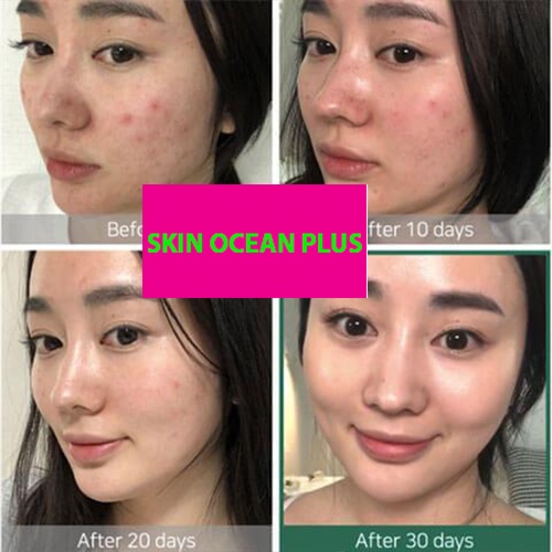 SERUM MỤN SKIN OCEAN PLUS ĐÁNH BAY MỤN HƠN 99% TÌNH TRẠNG MỤN TRÊN DA, MỜ THÂM TRẮNG DA HIỆU QUẢ | BigBuy360 - bigbuy360.vn