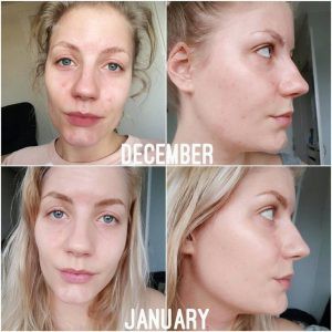 Serum The Ordinary Niacinamide 10 + zinc 1 trắng da , giảm dầu