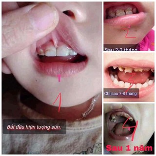 Thuốc chống sún sâu răng cho bé