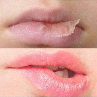 Vaseline viện bỏng Lê Hữu Trác