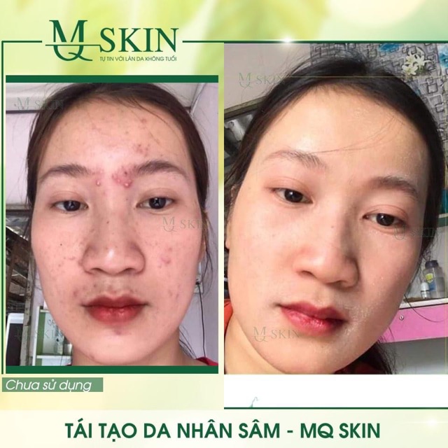 Serum tái tạo da nhân sâm MQskin ♥️Chính hãng♥️ Trị dứt điểm các vấn đề về da | BigBuy360 - bigbuy360.vn