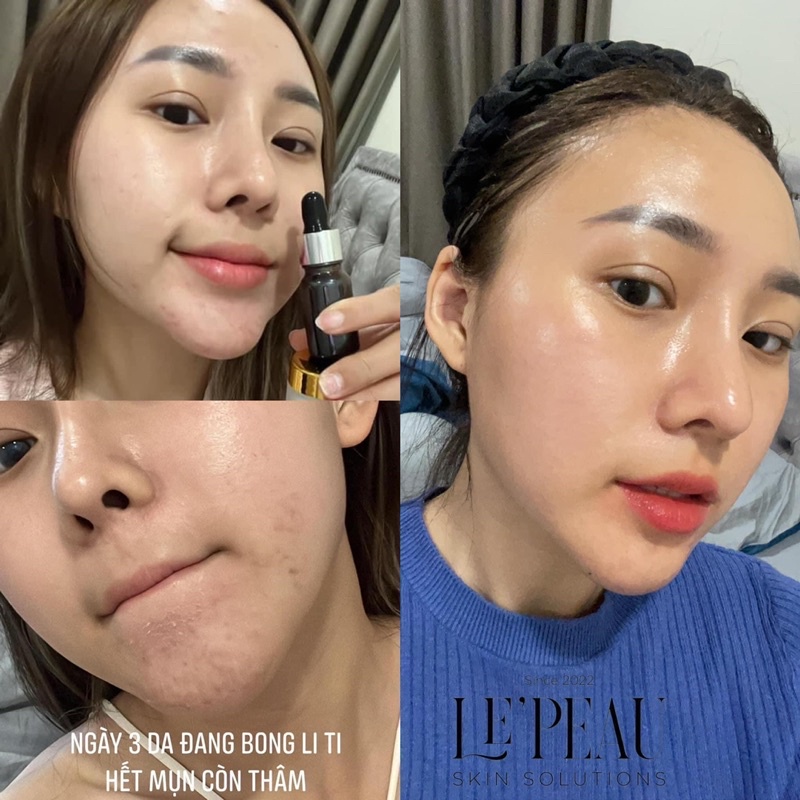 Peel da retinol vi tảo Le'Peau 10ml, Serum giảm mụn, tái tạo da sinh học, tặng kèm Serum B5 phục hồi,Hiệu quả sau 7 ngày