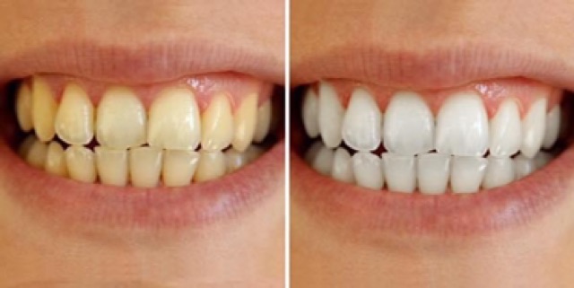 Dán trắng răng Crest 3D white