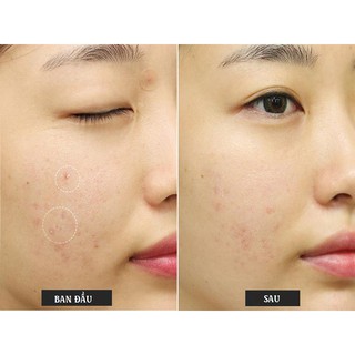 Lotion Chấm Mụn Bye-Bye Blemish For Acne