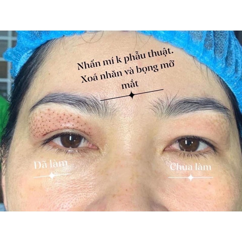 Máy nhấn mí PLASMA máy đốt 6 cấp độ Hàn Quốc