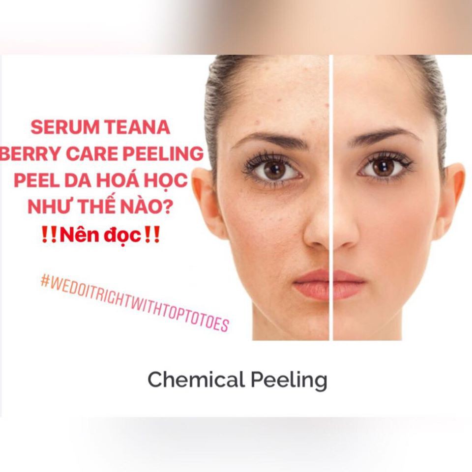 Serum peel da hoá học BERRY CARE PELLING hỗ trợ tẩy da chết hoá học nhẹ nhàng, tạo độ bóng, giảm thâm sẹo