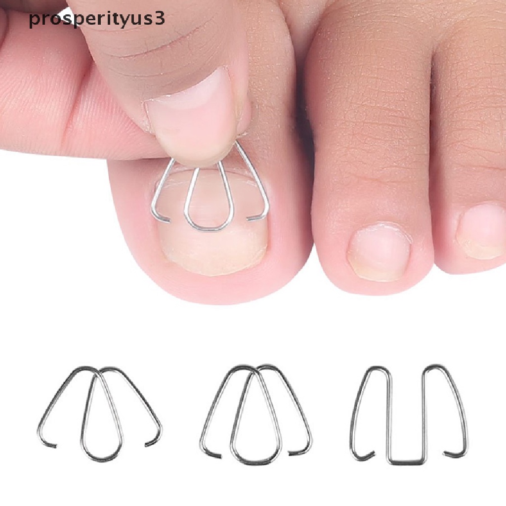 [prosperityus3] Nail Art Ingrown Toe Nail Correction Tool Toenail Nail Orthosis Paronychia Clip [new]