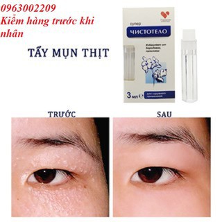 Thuốc chấm Mụn thị, Nốt ruồi, Mụn cóc, Mụn cơm Của Nga