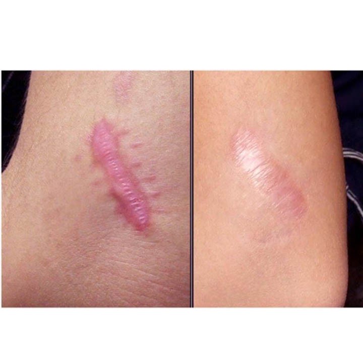 Kulscar Gel - Hỗ Trợ Điều Trị Vết Thương Hở & Hạn Chế Hình Thành Sẹo