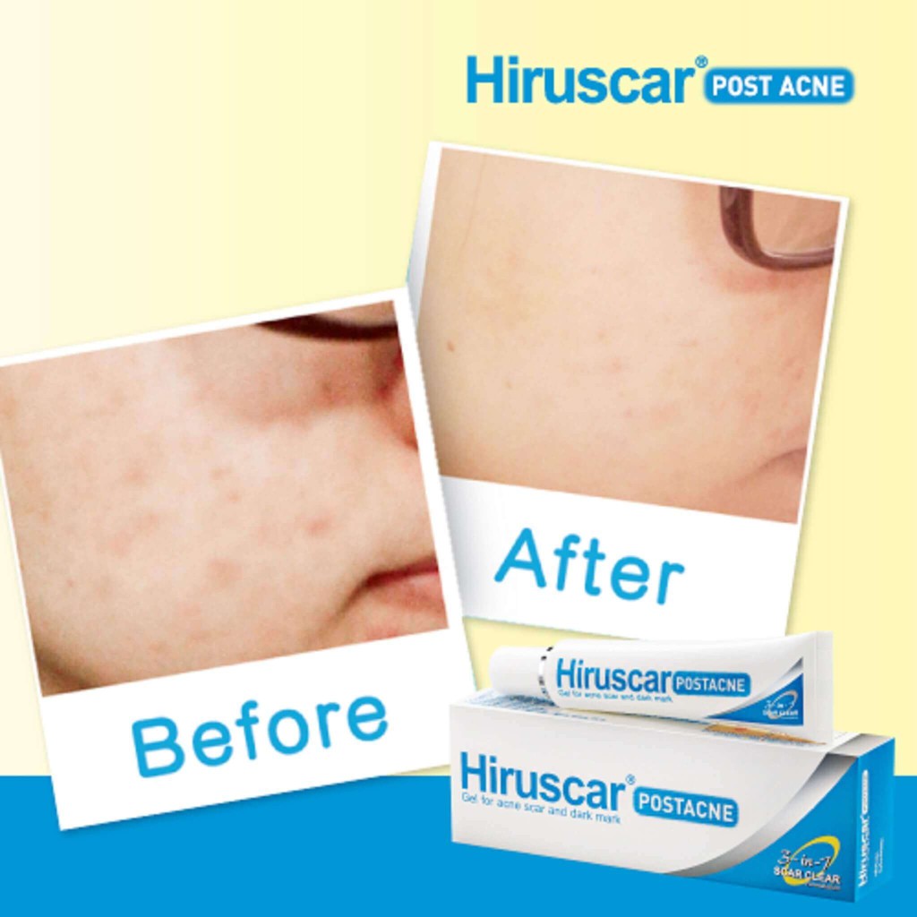 Hiruscar Post Acne Gel chăm sóc sẹo mụn và mụn thâm (5g)