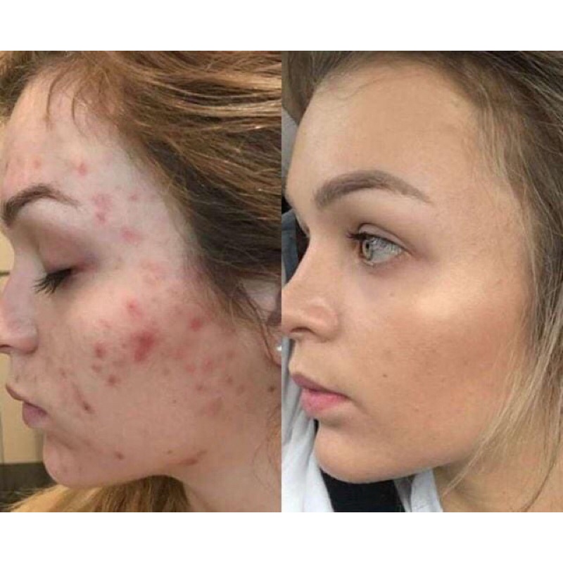 kem bôi mụn đầu đen sợi bã nhờn mờ thâm mụn dưỡng sáng da Azelaic Acid 20% | BigBuy360 - bigbuy360.vn