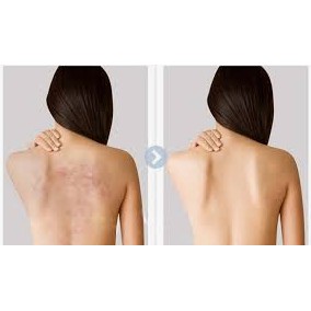 GEL DƯỠNG DA MỤN LƯNG DẠNG XỊT FOR BACK